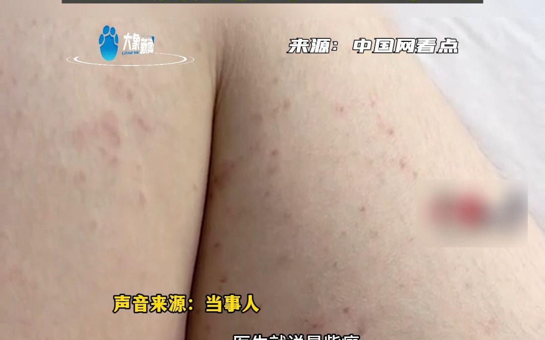 女子两三年凌晨1点左右睡,致免疫力低下确诊紫癜!哔哩哔哩bilibili