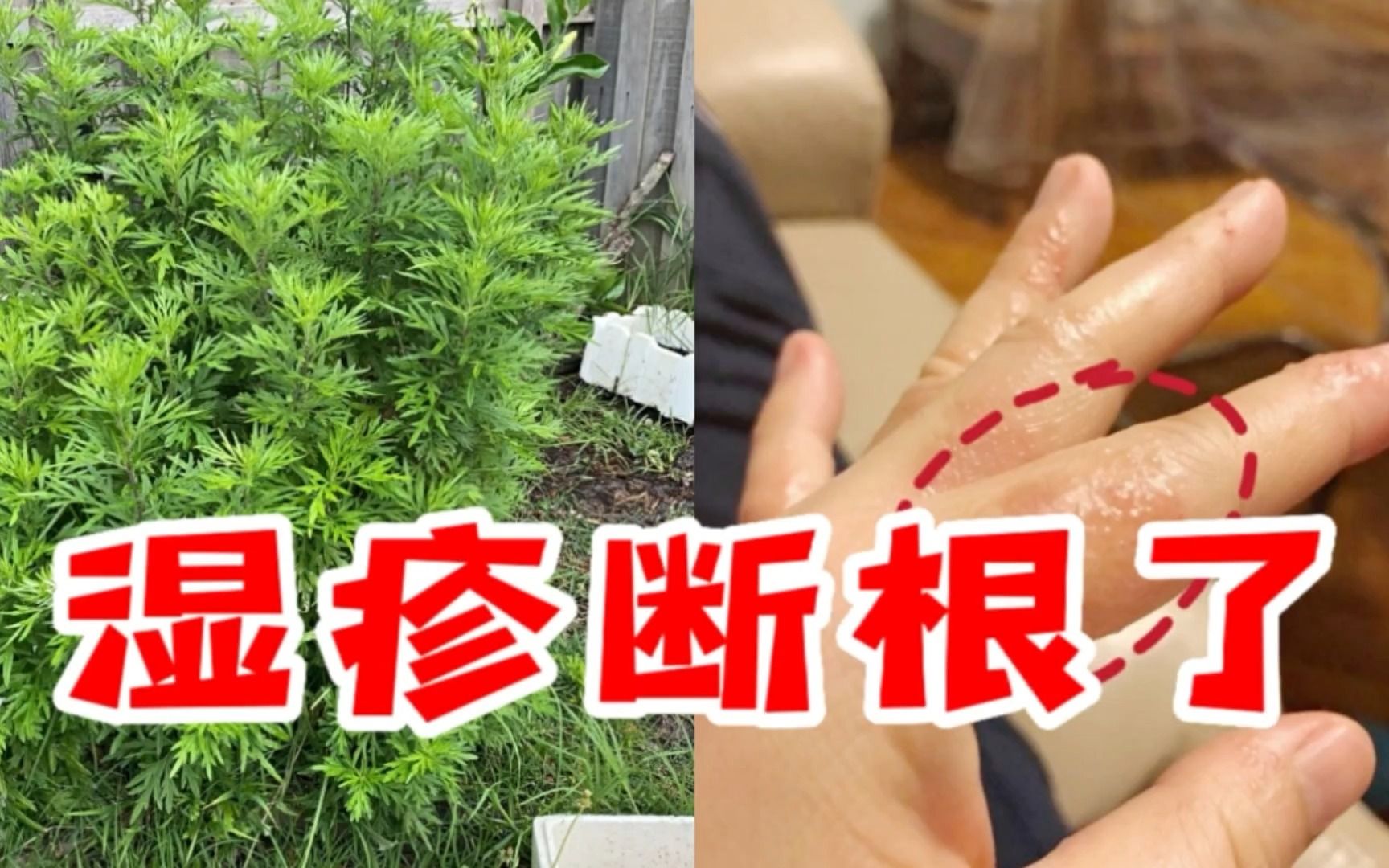 艾草去溼疹真的太絕了,溼疹直接斷根不長了,真的絕了!