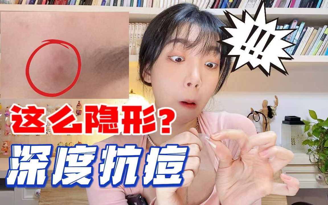 【痘贴怎么选?】一晚11个痘贴!痘肌手把手教你选痘痘贴!哔哩哔哩bilibili