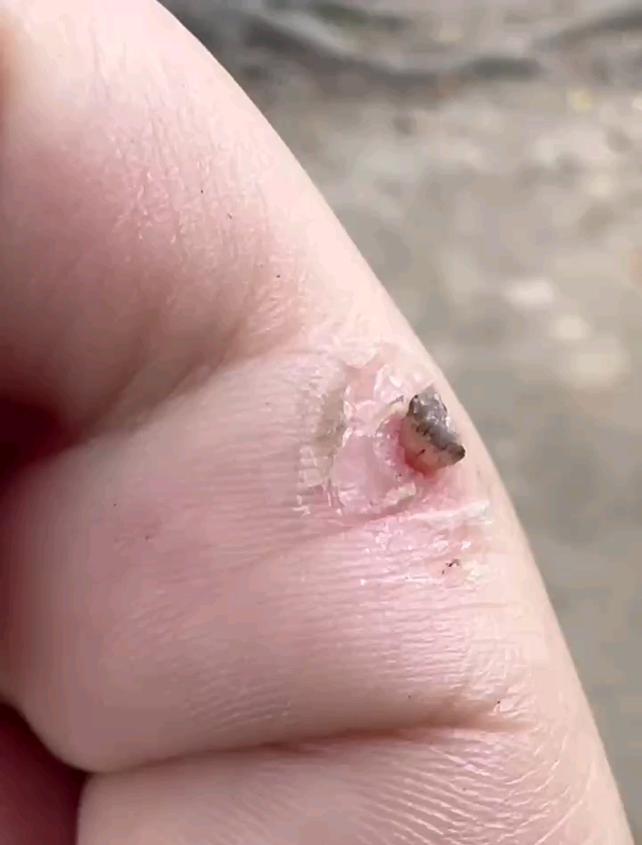 顽固寻常疣脱落过程太解压了吧