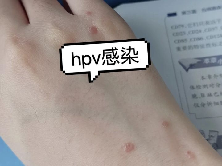 男性hpv 初期图片