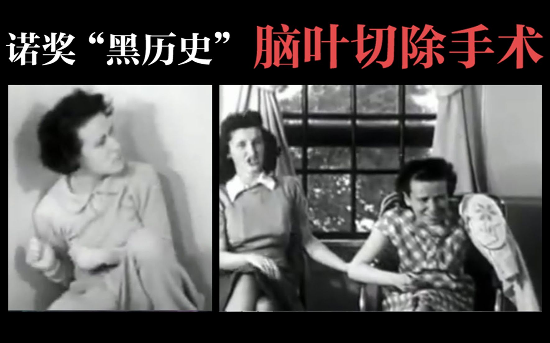 【诺贝尔奖黑历史:脑叶切除手术】1940年 患者手术前后录像(cc字幕)哔哩哔哩bilibili