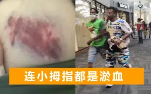 Download Video: 因英语不流利，华裔夫妇遭黑人暴打：妻子全身淤青，丈夫牙被打掉