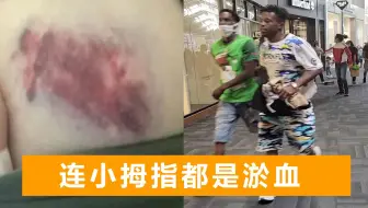 因英语不流利，华裔夫妇遭黑人暴打：妻子全身淤青，丈夫牙被打掉