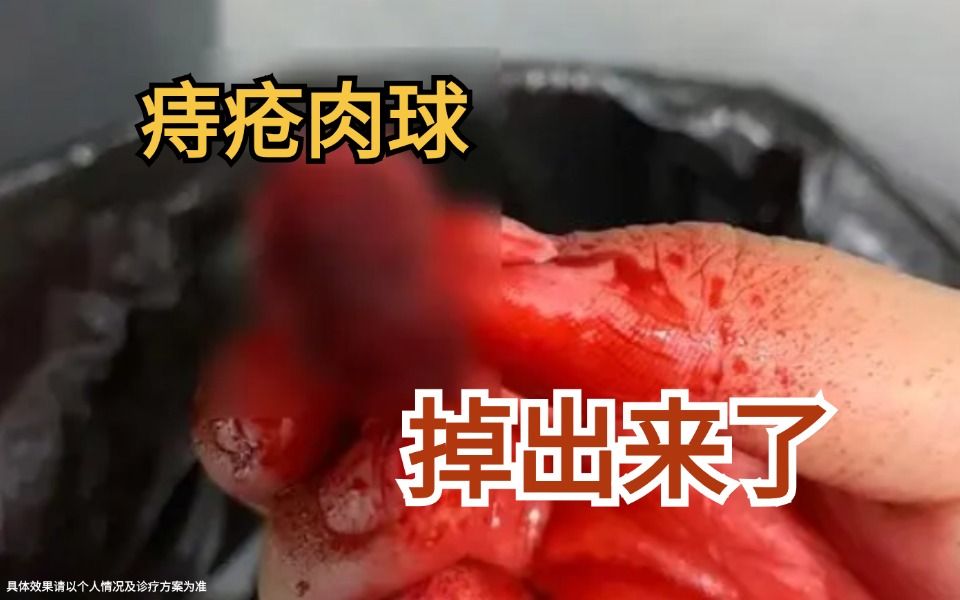 上厕所带血,这个时候痔疮已经开始严重了!