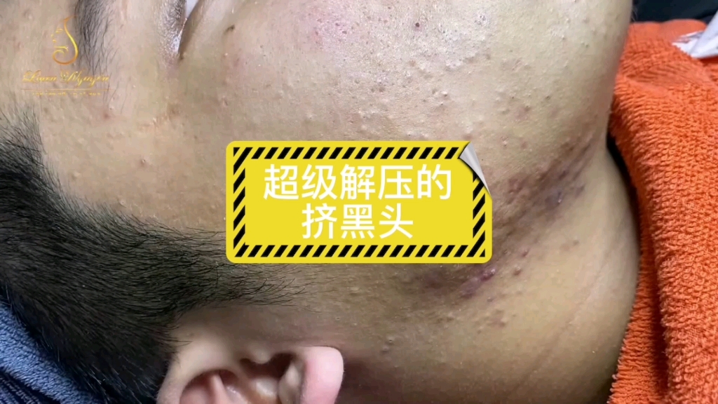 极度解压的挤黑头强迫症必看哔哩哔哩bilibili