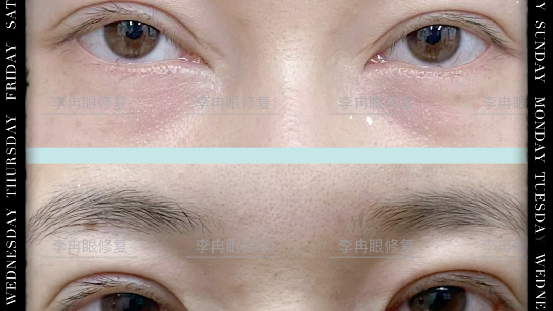 李冉内眼角回包修复案例赏析