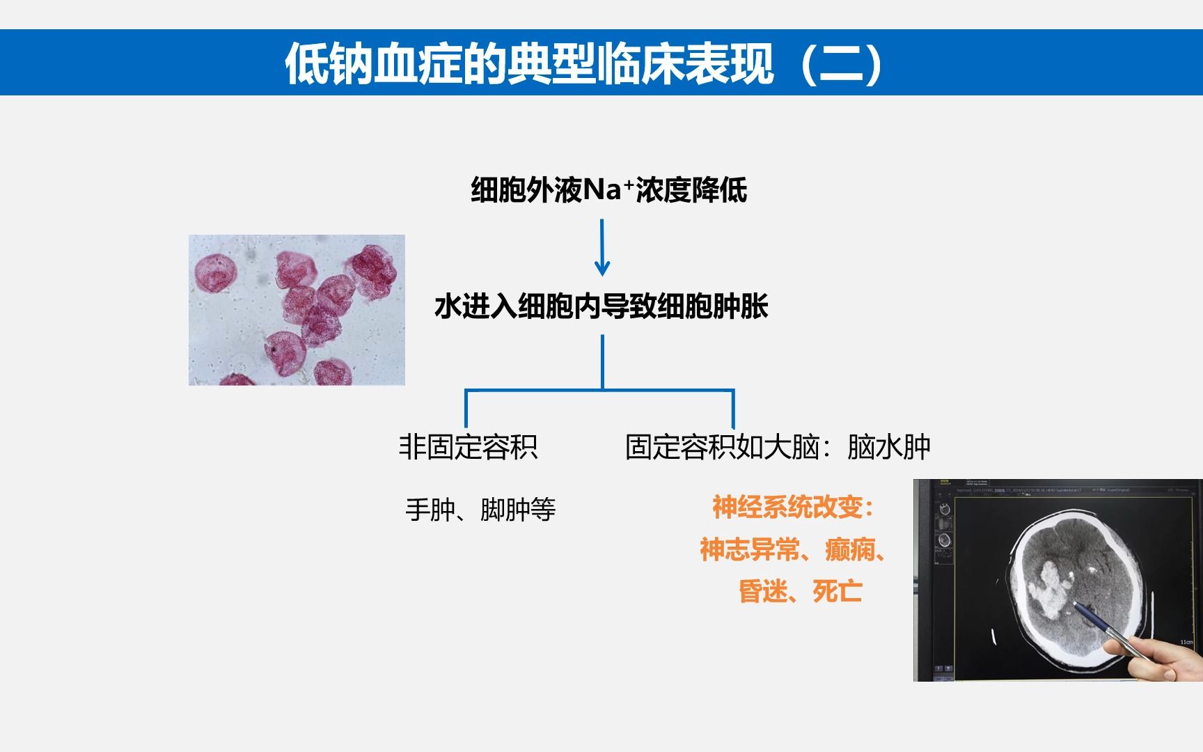 [图]低钠血症的诊治PPT