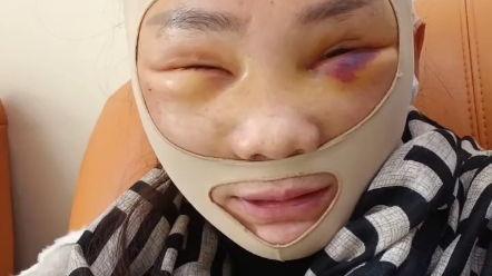 大拉皮术后第五天