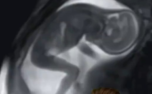 [图]子宫内婴儿的MRI视频。MRI video of a baby in the womb.