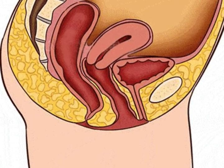 多少女性难以言说的痛——产后子宫脱垂