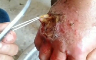 五步蛇咬伤,到底会有多严重,伤口有时候可怕到你不敢想象!