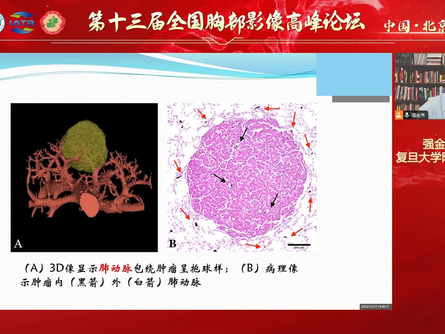 肺癌血供的再认识及其影像诊断意义强全伟哔哩哔哩bilibili