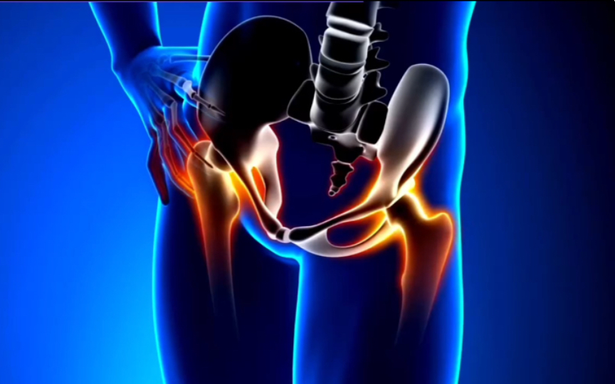 了解髋关节弹响综合征的三种类型_哔哩哔哩_bilibili