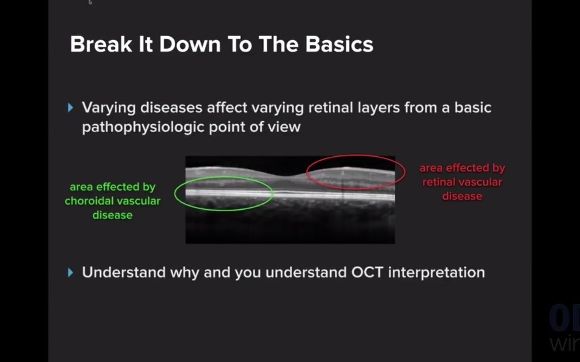 [图]【中英双字】【OCT解读+实战】Macular OCT Interpretation: A Practical Discussion