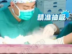 Download Video: 可视化面吸过程演示看完你还会吸脂吗？