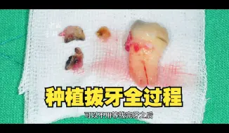 Скачать видео: 临床种植拔牙全过程，牙齿缺失需要种牙吗？