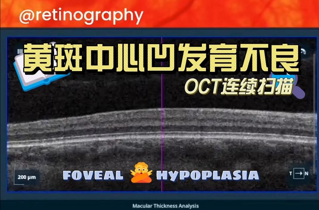 【白化病OCT:黄斑中心凹发育不良】Foveal hypoplasia in ocular albinism retina哔哩哔哩bilibili