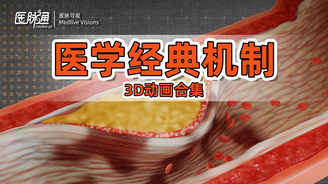 医学3D动画|冠心病是怎么发生的？
