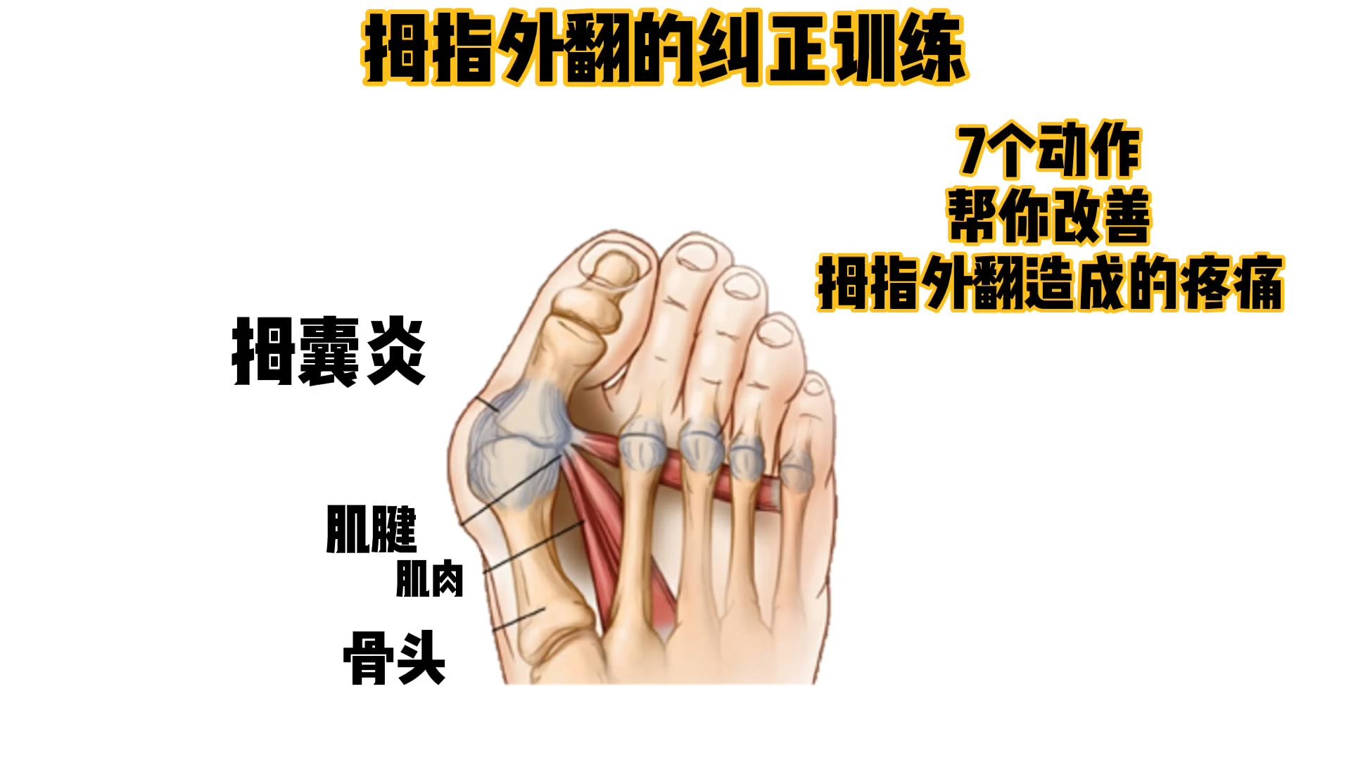 拇指外翻的纠正训练哔哩哔哩bilibili