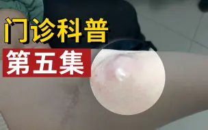 Download Video: 手臂长出巨大肿物，一查竟是恶性肿瘤复发，患者哭诉：我不想截肢！