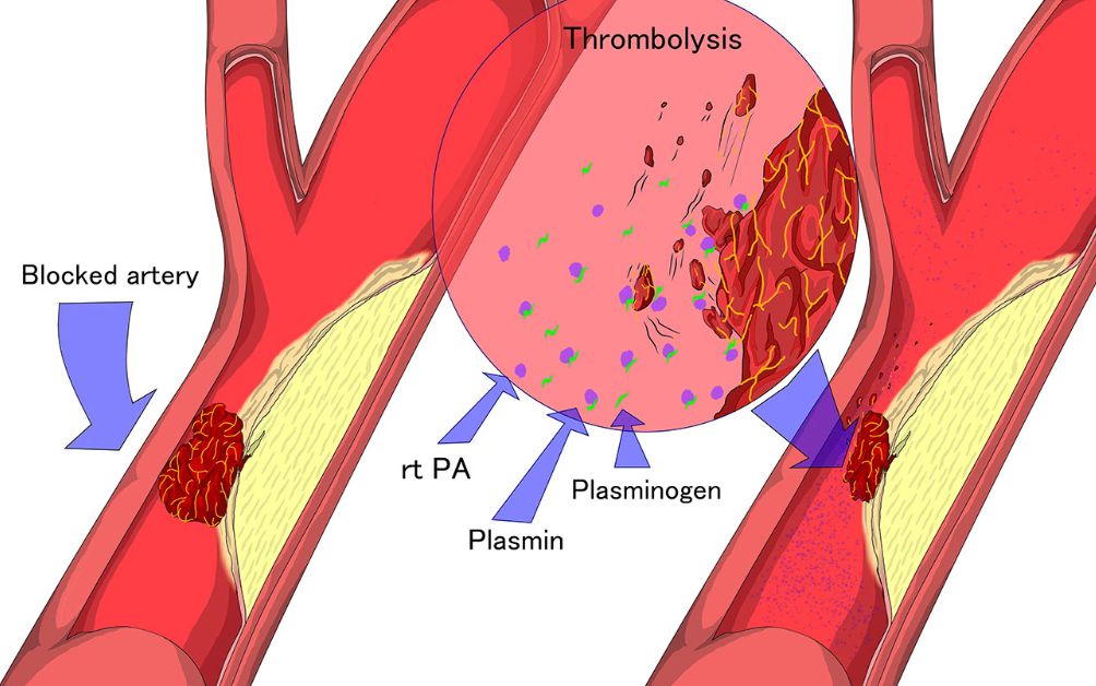阿替普酶溶栓图片图片