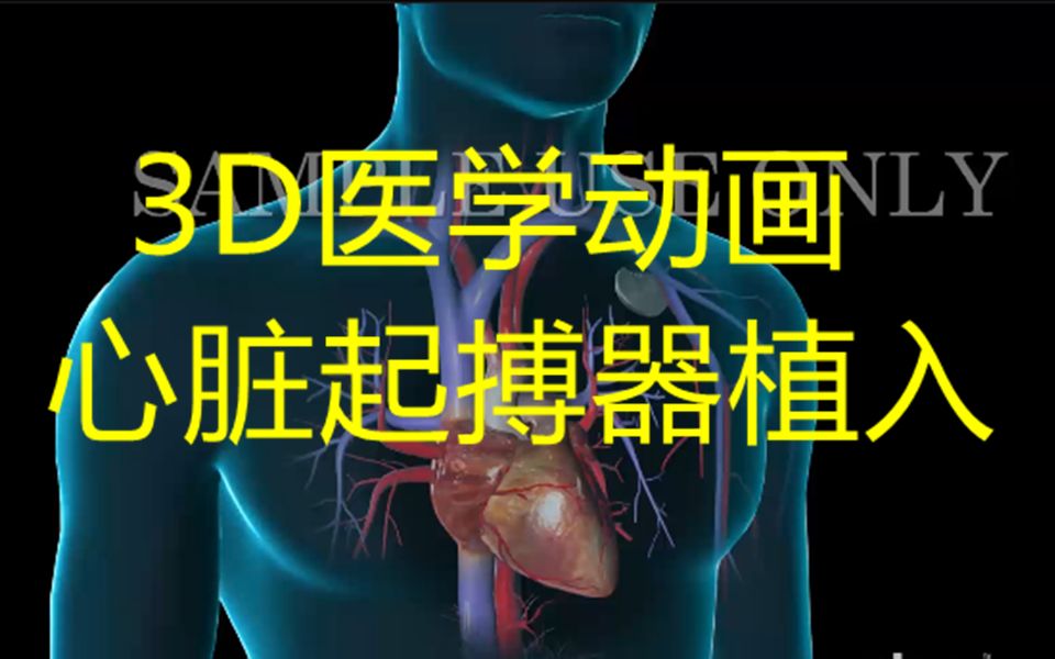 心脏起搏器的植入3D医学动画哔哩哔哩bilibili