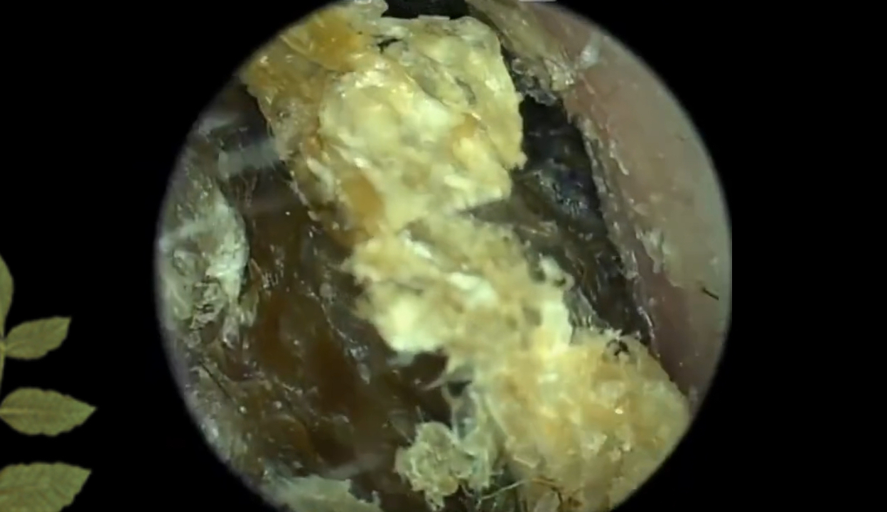 一辈子没掏过耳朵,整个耳道塞满了干巴巴的耳屎