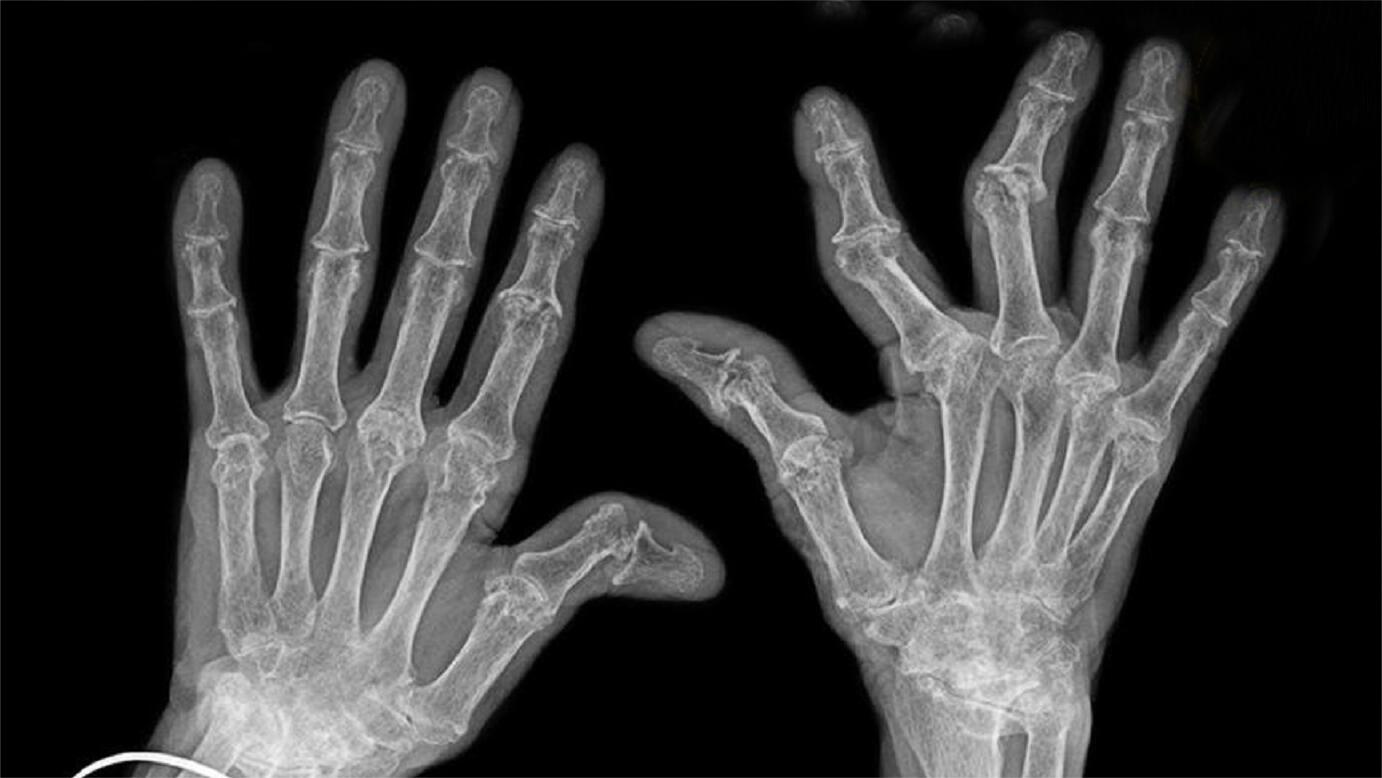 当你掰关节时到底会发生什么?掰手指真的会得关节炎?