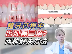 Descargar video: 义乌整牙丨正畸过程中出现黑三角怎么办？两种方法