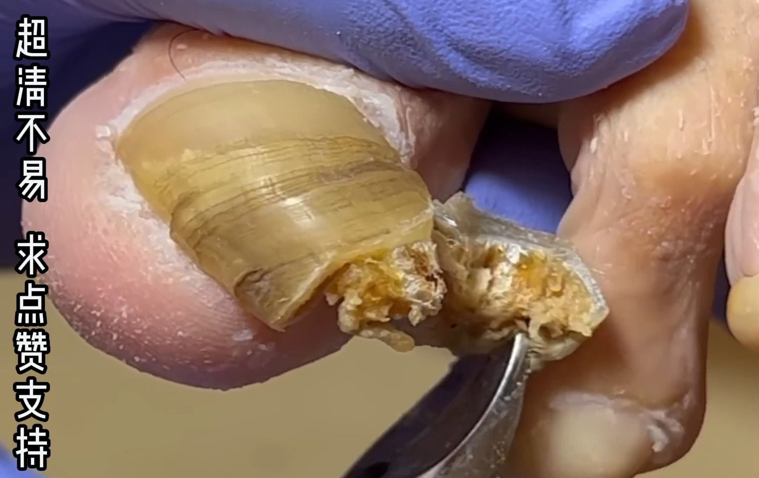 超长超脏的灰指甲,完整取下