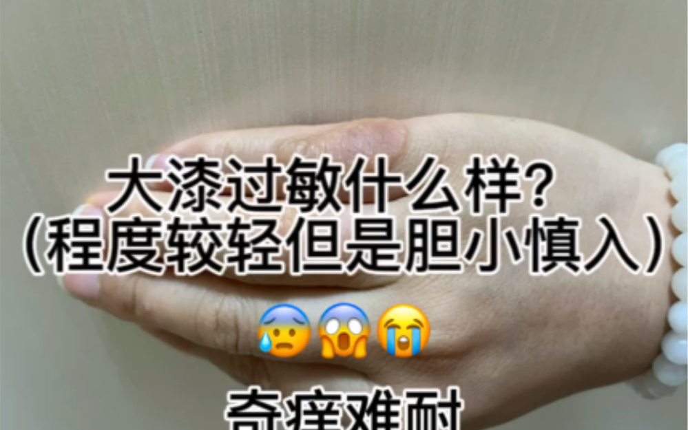 大漆过敏是什么样的哔哩哔哩bilibili