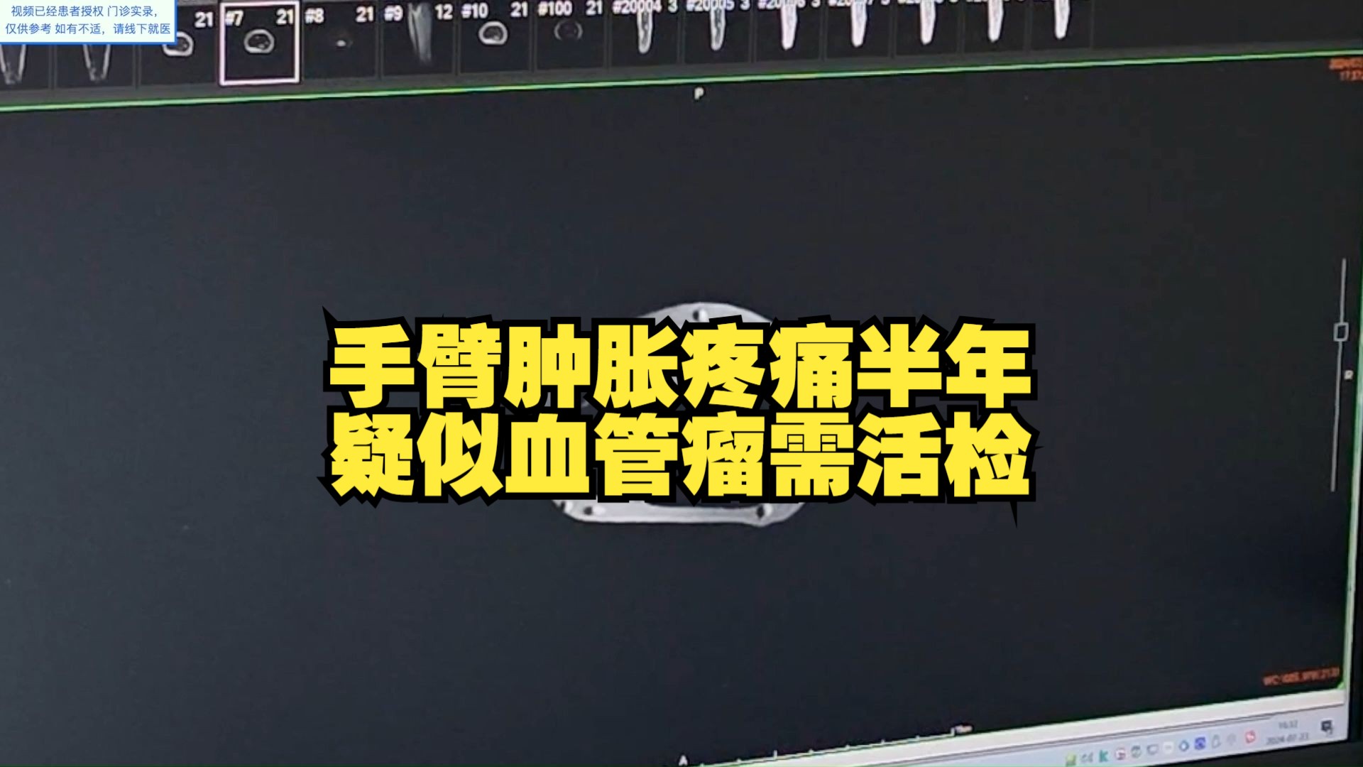 手臂长肿物半年,伴有疼痛,影像检查考虑血管瘤.哔哩哔哩bilibili