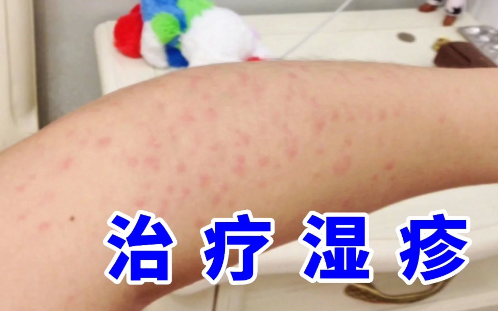 这一招让我轻松摆脱湿疹红疹!彻底服了