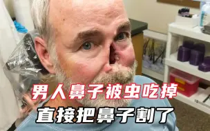 Скачать видео: 男人的鼻子被虫吃空，每天都在痛苦中度过，没办法的他将鼻子割掉