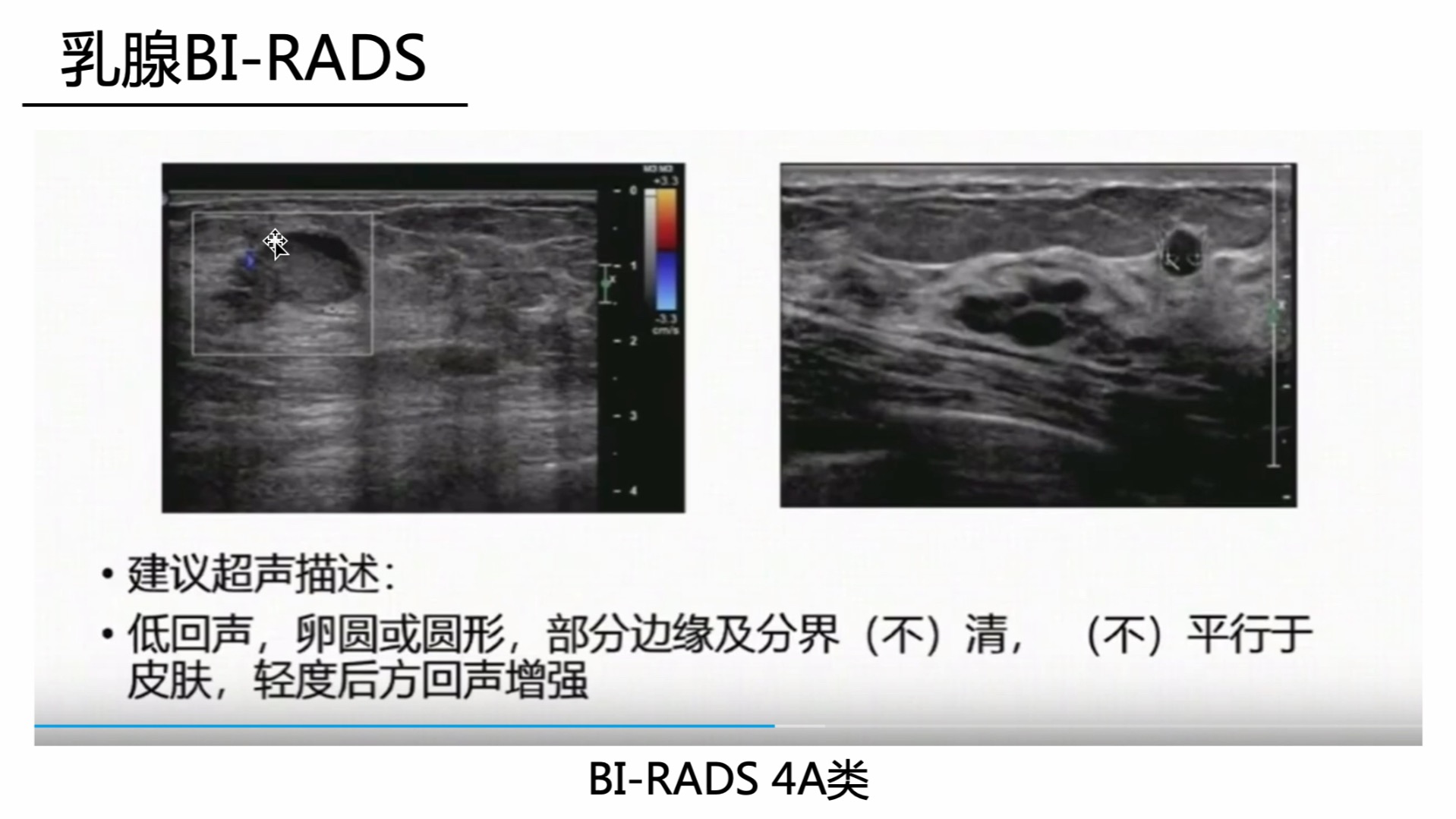 怎么看甲状腺乳腺结节的超声图像?哔哩哔哩bilibili