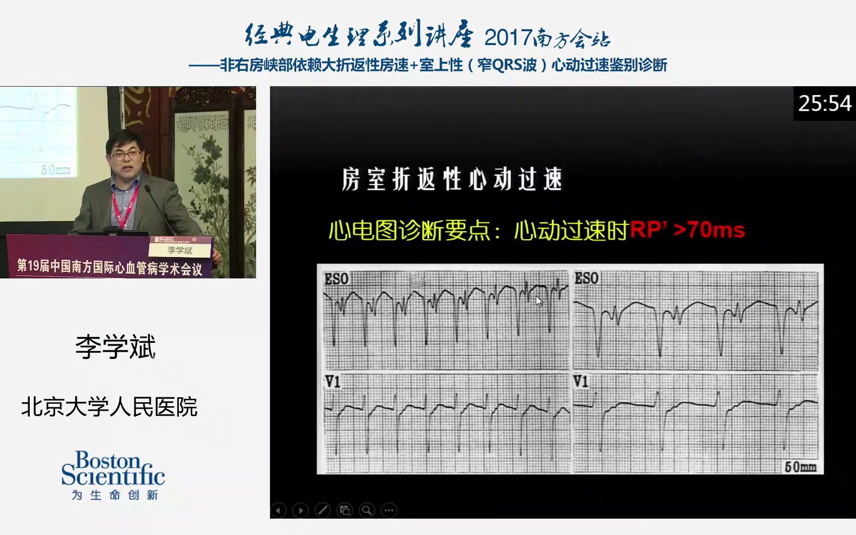 8李学斌窄QRS波心动过速临床表现和心电图特点的鉴别诊断意义哔哩哔哩bilibili