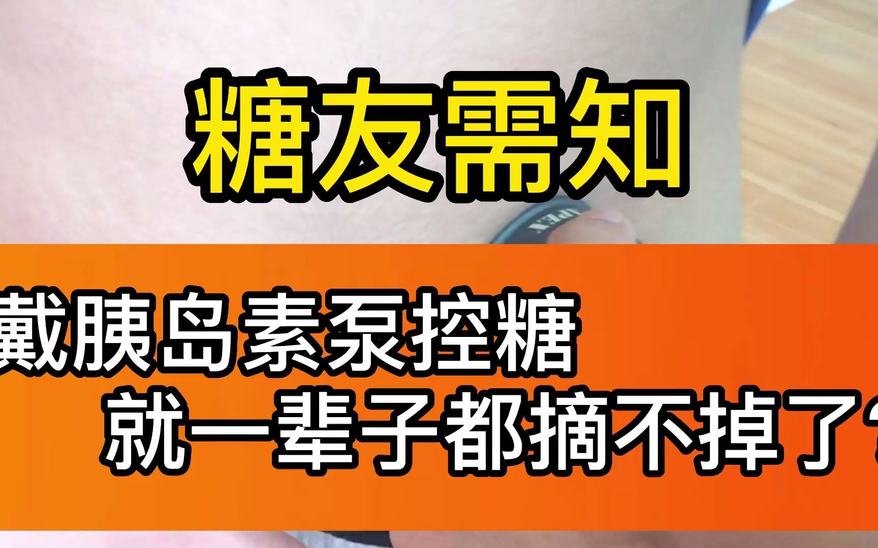 戴泵了一辈子摘不掉?糖友一定要掌握好这三个摘泵时机哔哩哔哩bilibili