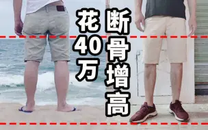 Video herunterladen: 术后一年反馈！除了手术，成人还能这样长高3～5厘米