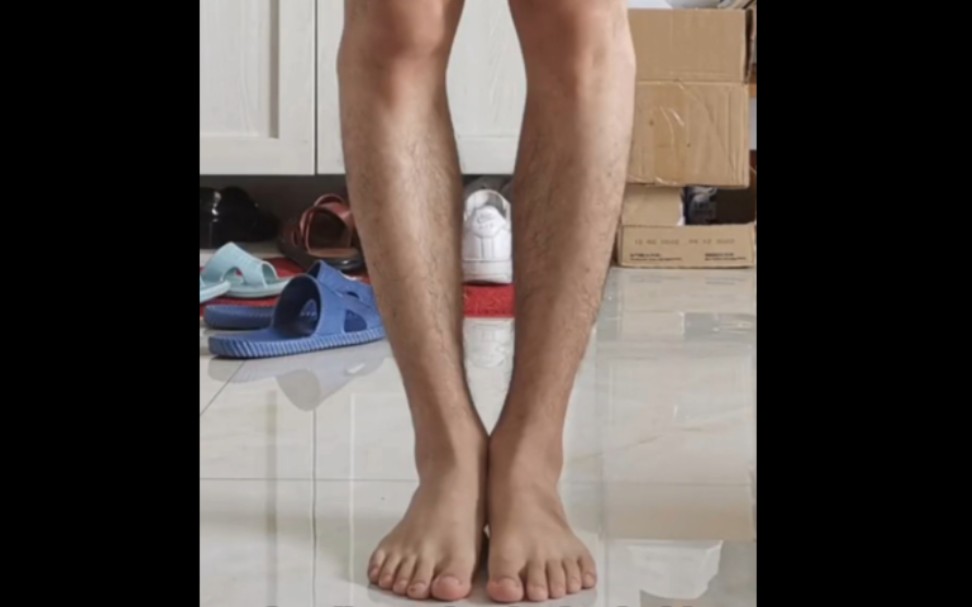 腿型分辨(二)本期内容:胫骨平台外移 #纠正腿型 #小腿外翻 #直腿