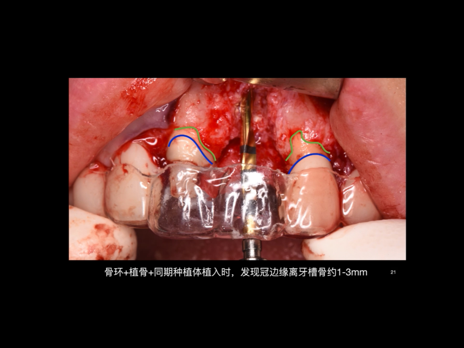 牙周的多学科合作——修复3冠延长挑战传统附着概念——吕达牙周课哔哩哔哩bilibili