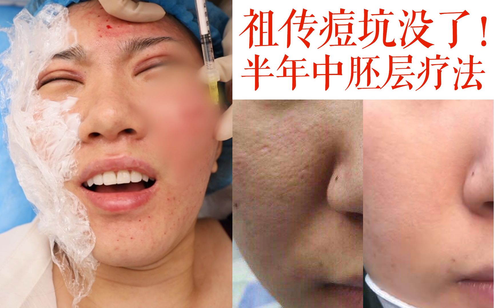 水光针微针最全干货半年5次中胚层疗法祖传痘坑终于没了我不自卑了