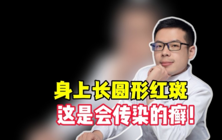 身上长圆形红斑这是会传染的癣!哔哩哔哩bilibili