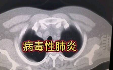 分享一例确诊为病毒性肺炎的CT影像学表现,以模玻璃密度影为主!哔哩哔哩bilibili