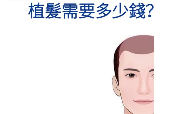 [图]不同類型的脫髮治療，植髮需要多少錢？Yonghe hair transplant