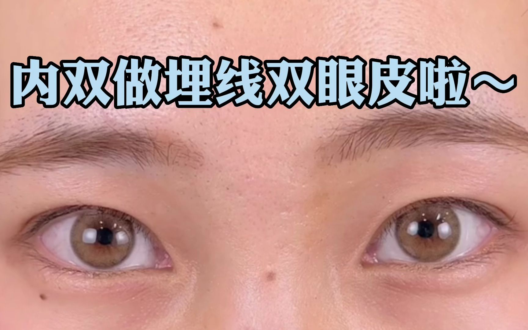 内双做埋线双眼皮啦!