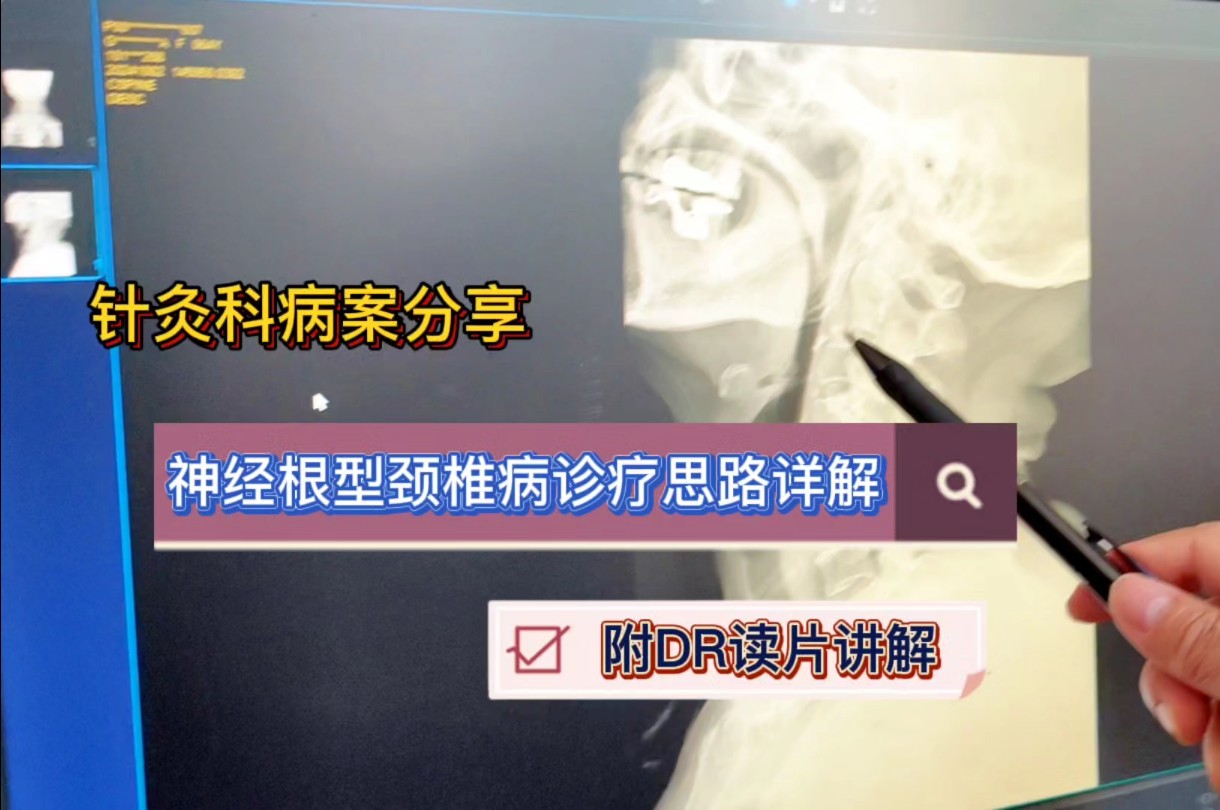 针灸科病案分享,神经根型颈椎病诊疗思路详解,附DR读片讲解哔哩哔哩bilibili