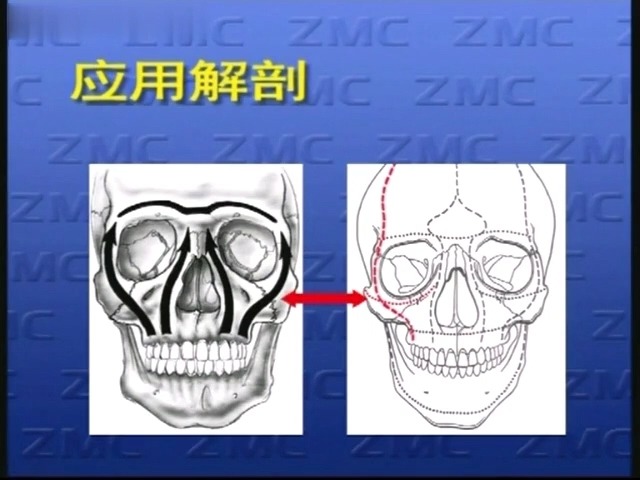 2颧骨应用解剖哔哩哔哩bilibili