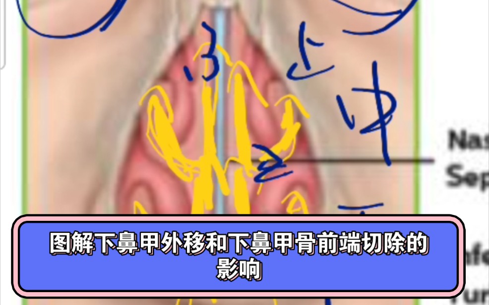 九:错误的下鼻甲外移会导致新的空鼻症哔哩哔哩bilibili