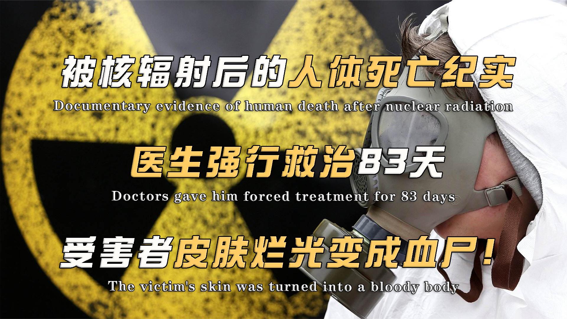 人被核辐射后有多惨?医生强行救治83天,受害者皮肤烂光变成血尸